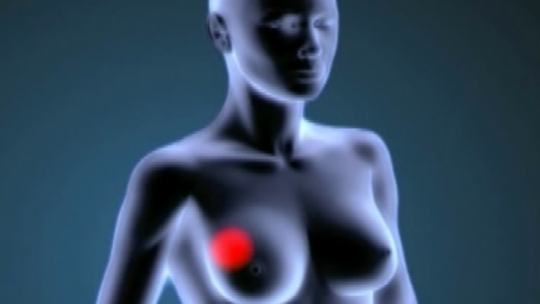 Tot i la gran varietat d'agents antitumorals, molts tractaments fallen amb el temps per a tumors sòlids en estadis avançats, inclòs el càncer de mama.