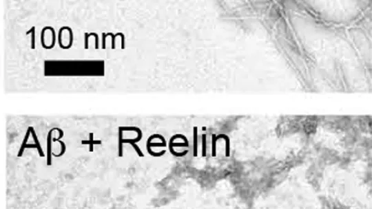 Reelin delays the formation of amyloid-beta (A&#946.) fibrils. Top picture A&#946. peptide only and bottom picture with reelin. In both cases, the incubation was for 11 days. (Giralt's lab at IRB)