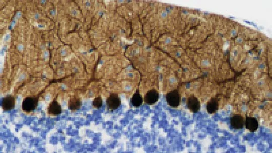 Comparative microscope images. The lower picture shows a cerebellum sample from a healthy mouse. Above, the same tissue after glycogen accumulation. (Jordi Duran. IRB Barcelona)