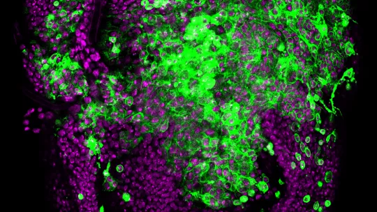   Drosophila epithelium subjected to chromosomal instability (CIN): cells start invading the neighbouring tissues. Magenta labels the nuclei of all the epithelium while green labels the membranes of cells subjected to CIN (L Barrio, IRB Barcelona)