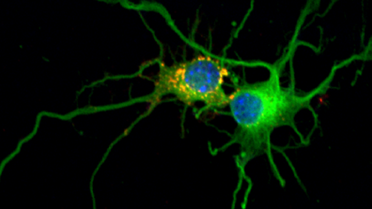 Imagen obtenida por microscopia confocal. La acumulación de glucógeno (amarillo y rojo) en las neuronas provoca que se deterioren y finalmente mueran (IRB Barcelona)