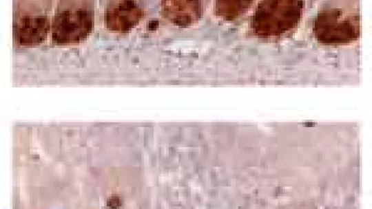 Healthy intestinal crypts (upper image) maintain different cell types in their compartments. Cells located at the bottom of the crypt (lower image) in which ADAM10 is blocked (lower image) migrate to the upper cell compartment (cells in dark brown)