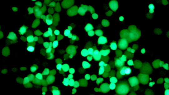 The image shows tumour cells infected by the virus, which expresses a fluorescent protein. Over the days (in the image fifth day), the virus multiplies, generating new virions that infect more cancer cells (IDIBAPS, IRB Barcelona)