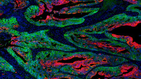 L'heterogeneïtat del tumor: cèl·lules mare del càncer (verdes) i cèl·lules diferenciades (en vermell). IRB Barcelona.