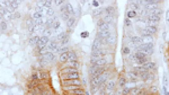 Intestinal epithelium with tumour stem cells marked in brown.