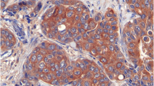 Breast tumours have high levels of LIPG expression (F Slebe, IRB Barcelona)