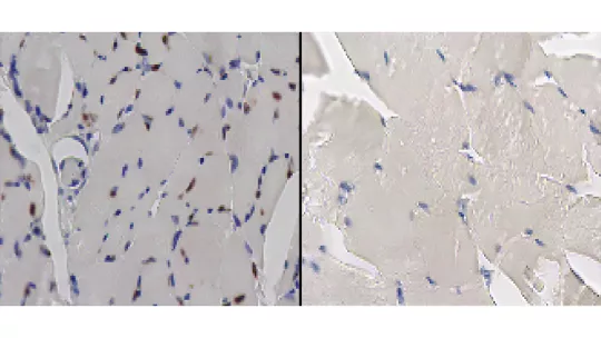 Tejido muscular de ratón. En la derecha, la proteína AR se acumula y forma agregados (en marrón) debido a las colas de más de 38 glutaminas; en la izquierda, el tejido está libre de agregados porque la cadena es más corta (B. Eftekharzadeh, IRB Barcelona)