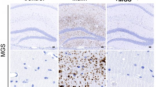 Lafora bodies in brain sections (hippocampus). Bodies that accumulate in the disease disappear when the ability of astrocytes to produce glycogen is removed. 