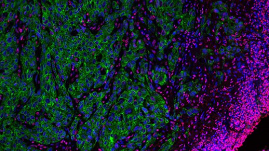 Un front invasiu de cèl·lules tumorals altament agressives (en verd). Imatge de microscòpia confocal. Alexandra Avgustinova, IRB Barcelona. 
