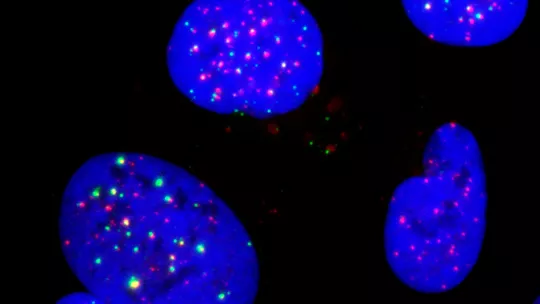 Células cancerosas con inhibición de la TLK muestran intermediarios de replicación (verde) en los extremos de los cromosomas (rojo) - (IRB Barcelona).