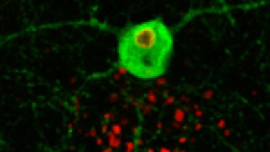 Interneuron obtained from an engineered mouse lacking the malin gene (in green) and showing the accumulation of Lafora bodies (in red).