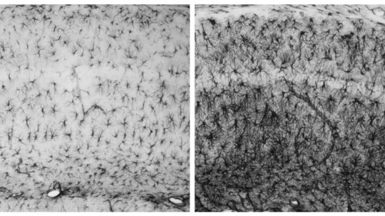 Microscopy image comparing the brain of a healthy mouse (left) with that of a mouse with neurodegeneration caused by the absence of malin, gene that is mutated in patients with Lafora disease (J. Duran, IRB Barcelona)