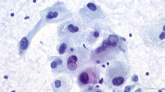 Malignant melanoma. Image: 3/24. 