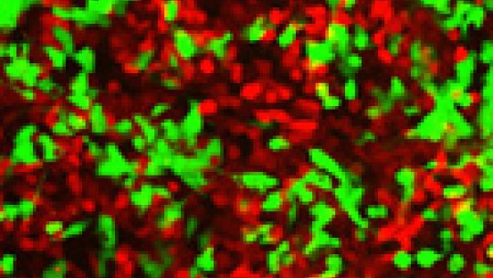 In vitro culture of colon cancer tumour cells. The tumour cells (in green) have deactivated the positional receptors and spread to invade the tissue occupied by the red cells.<br />
