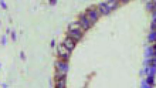 The image on the left shows healthy pancreas tissue, without CEPB4, and that on the right a pancreas with tumors (brown shows the distribution of CEPB4 protein).