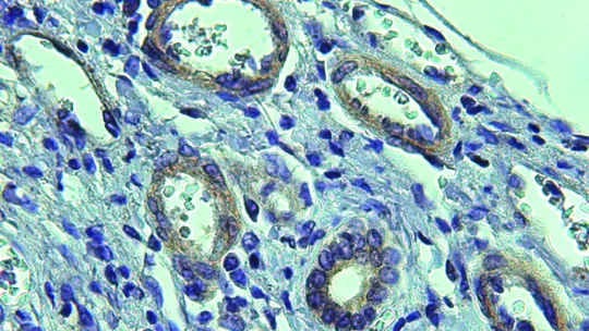 Vasos patológicos (círculos blancos), con abundante expresión de la proteína CPEB4, en tejido cirrótico (IRB Barcelona/IDIBAPS)