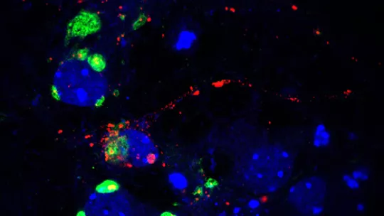 Neurons accumulate glycogen in small amounts, which is beneficial for them.  Glycogen synthase (in green) and glycogen accumulation in red (Author:  Isabel Sáez, IRB)