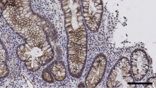 Intestí de pacient amb Colitis Ulcerosa, una malaltia intestinal inflamatòria crònica. En marró: receptor d'IGF1 activat, en blau: nucli. Autor: Catrin Youssif, IRB Barcelona.
