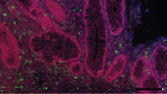 Intestine of a patient  with ulcerative colitis, a chronic inflammatory disease of the intestine. Macrophage marker is shown in green, activated p38 protein in red, and nucleus in blue. Author: Catrin Youssif, IRB Barcelona 