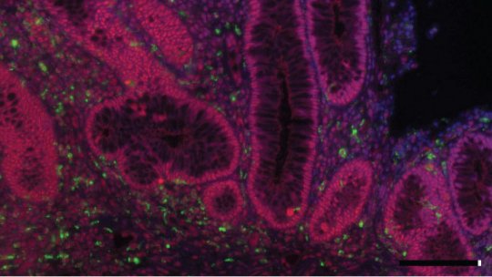 Intestino de paciente con Colitis Ulcerosa, una enfermedad intestinal inflamatoria crónica. En verde: marcador de macrófago, en rojo: proteína p38 activada, en azul: núcleo. Autor: Catrin Youssif, IRB Barcelona