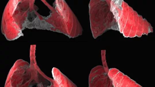 La figura muestra dos vistas, frontal y lateral, de la imagen obtenida por TAC de los pulmones de un ratón con fibrosis (zonas grises) antes y después de ser tratado con nanoterapia dirigida a las células senescentes. (G Garaulet i F Mulero, CNIO)  