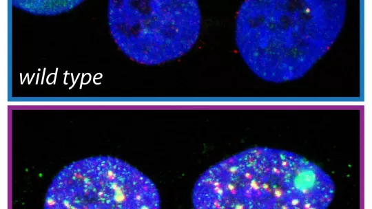 La inhibición de TLK conduce al estrés replicativo (verde) y a daño extensivo en el ADN (rojo) en células cancerosas cultivadas. Sandra Segura-Bayona, IRB Barcelona.