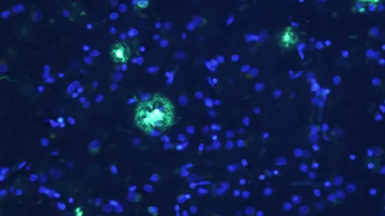 Alzheimer's disease brain. In blue, neuronal bodies and in green amyloid plaques. (Author: Alberto Serrano-Pozo, Massachusetts General Hospital)