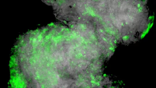 Epithelial tumor (in grey), expressing the Matrix Metalloproteinase MMP1, that helps degradate the membrane (in green)  © M. Milán lab, IRB Barcelona. Author: Mariana Muzzopappa