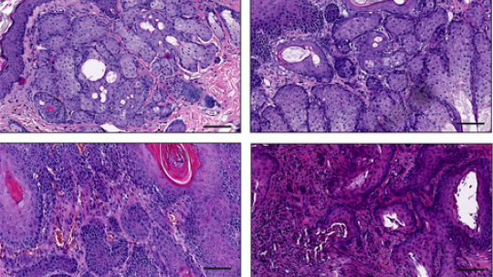 Imágenes representativas de diferentes subtipos de tumores de piel (L. Rinaldi, IRB Barcelona)