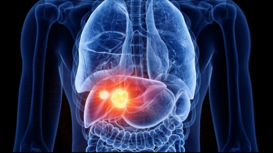 Imagen creada por ordenador de un cáncer de hígado (SEBASTIAN KAULITZKI/SCIENCE PHOT / Getty)