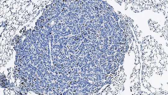 Tumor de pulmón teñido para marcar células en proliferación (marrón) (IRB Barcelona)
