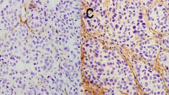 The image on the left shows how the pancreatic tumor enters remission when CEPB4 protein expression is removed while that on the right shows that tumor tissue grows in the presence of CEPB4 through the development of new blood vessels.
