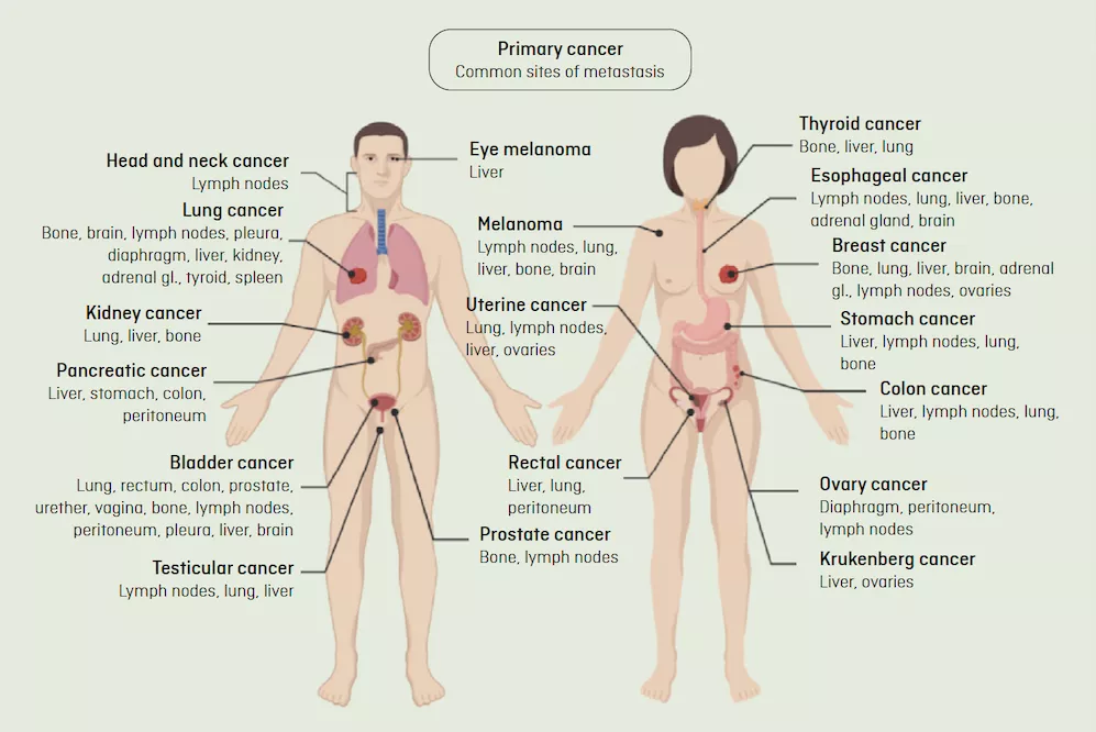 Picture with common vital organs affected by metastasis depending on where the primary tumour is, broken down by the male and female bodies