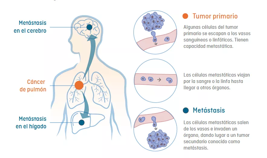 Infografía de cómo se genera la metástasis: expansión de las células cancerosas de un tumor primario a otros órganos vitales del cuerpo