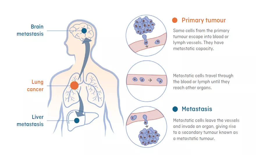 Infographic about how metastasis develops: spread of cancer cells from the primary tumour to other vital organs